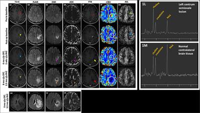 Conventional and Advanced Imaging Techniques in Post-treatment Glioma Imaging